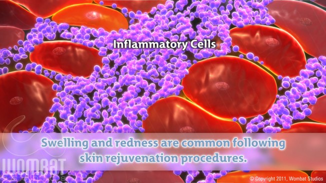 Inflammation Before Treatment