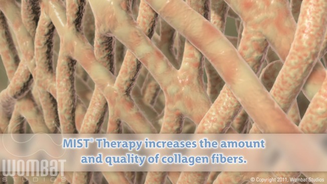 Collagen Fibers After Treatment