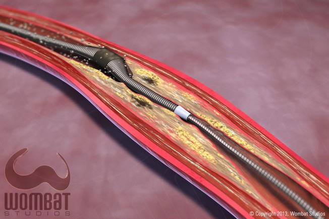 Spectranetics - Competitor Device, Position 1