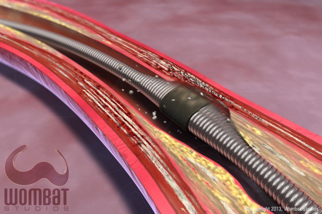 Spectranetics - Competitor Device, Position 2