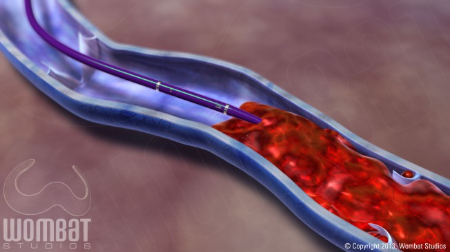 Deep Vein Thrombosis (DVT) - Positioned at Thrombus