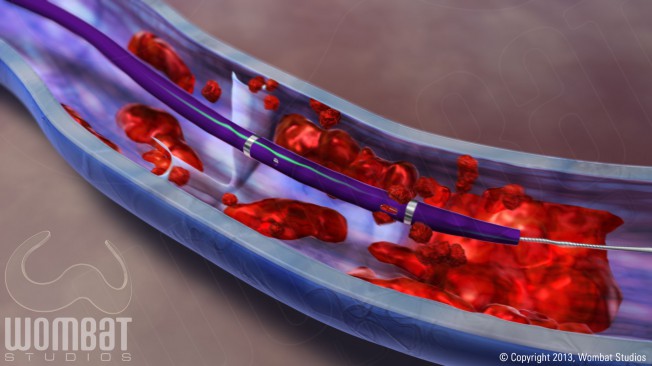 DVT - Removing Thrombus