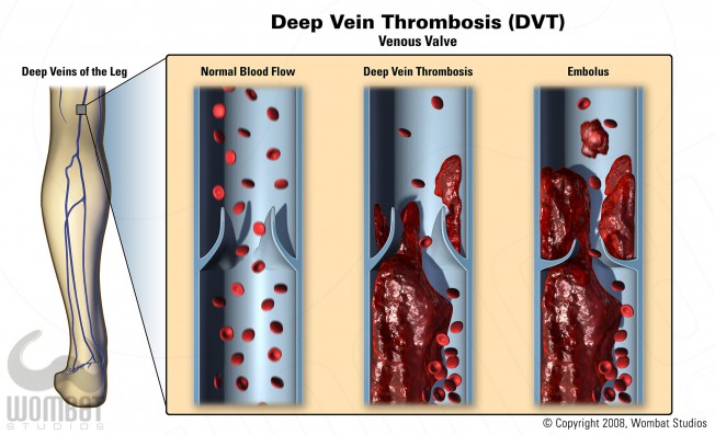 Deep Vein Thrombosis