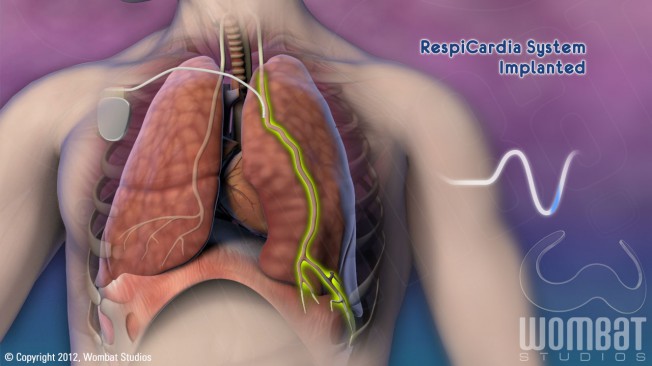 Patient Video - Implanted System