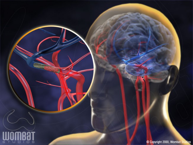 AngioJet and Brain Clot