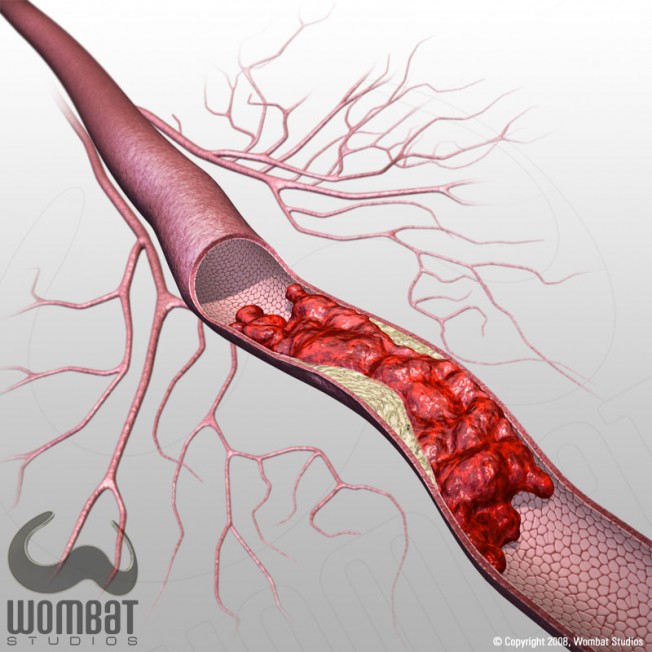 Vessels and Thrombus