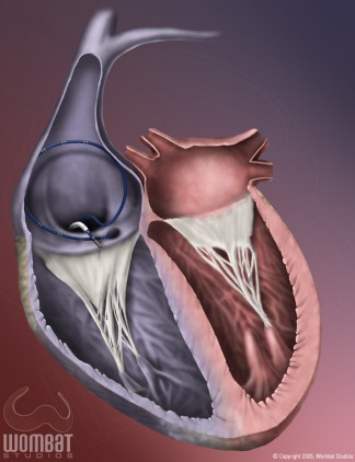 Catheters in Heart