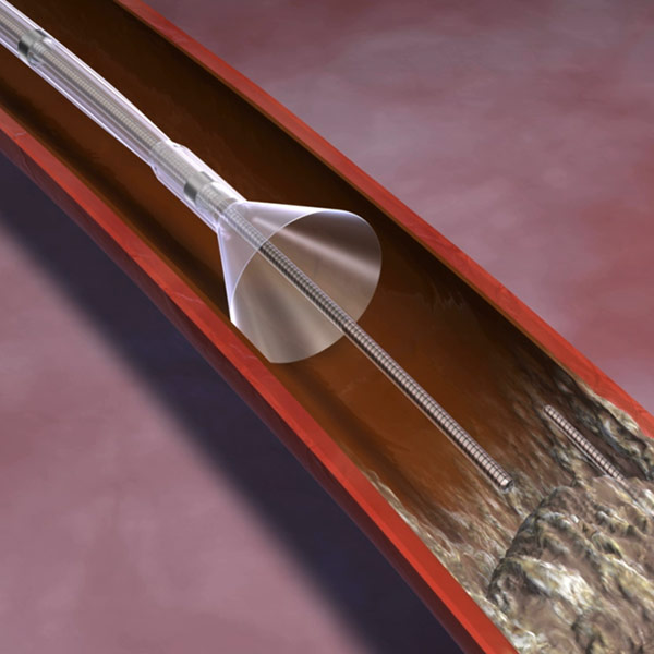 Spectranetics - Guiding Balloon Catheter