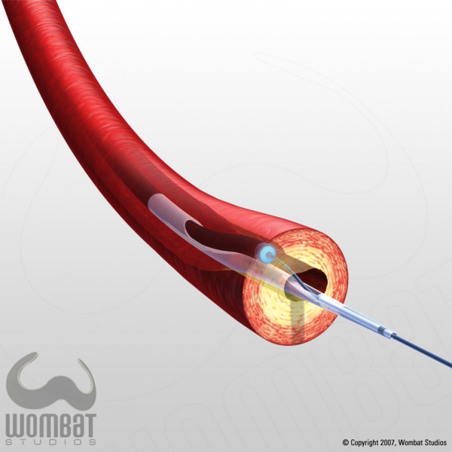 Turbo Booster and Vessel