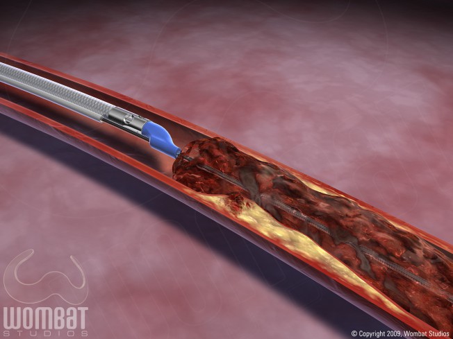 ThromCat Tip - Positioned Before Thrombus