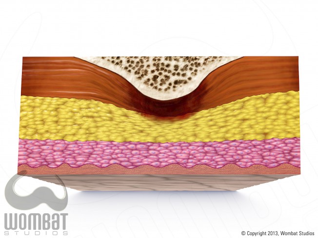 Skin Layers - Deep Tissue Injury (DTI)