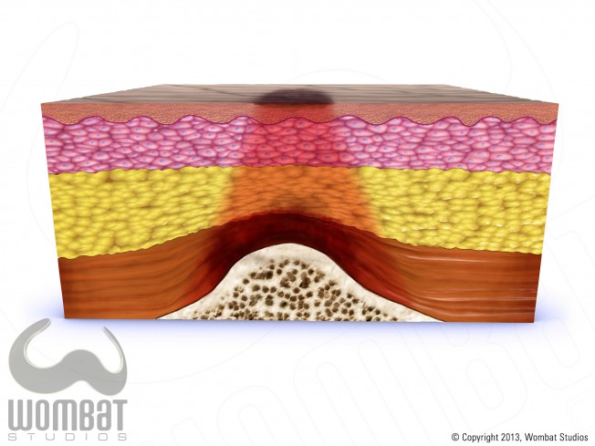 Skin Layers - DTI at Risk