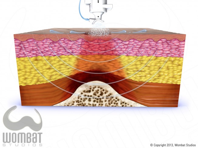 Skin Layers - DTI with Treatment