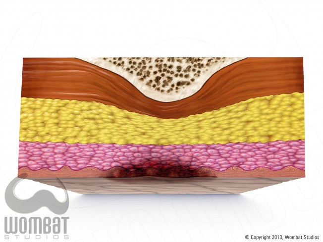 Skin Layers - Surface Pressure Ulcer (SPU)