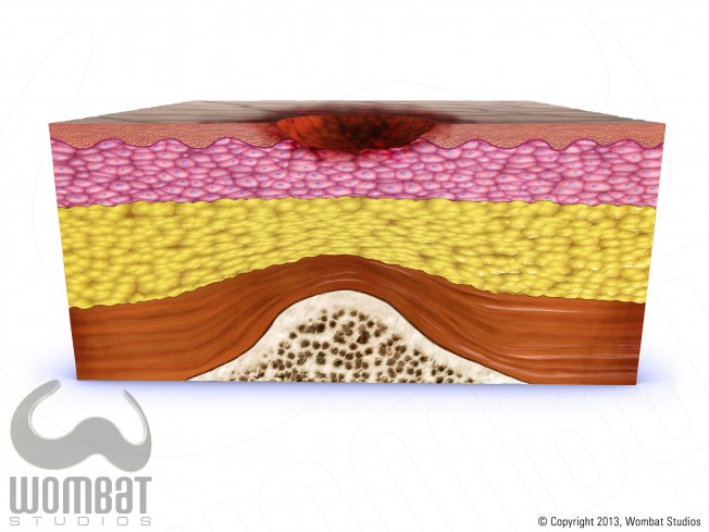 Skin Layers - Stage 2 Pressure Ulcer