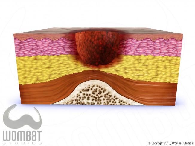 Skin Layers - Stage 3 Pressure Ulcer