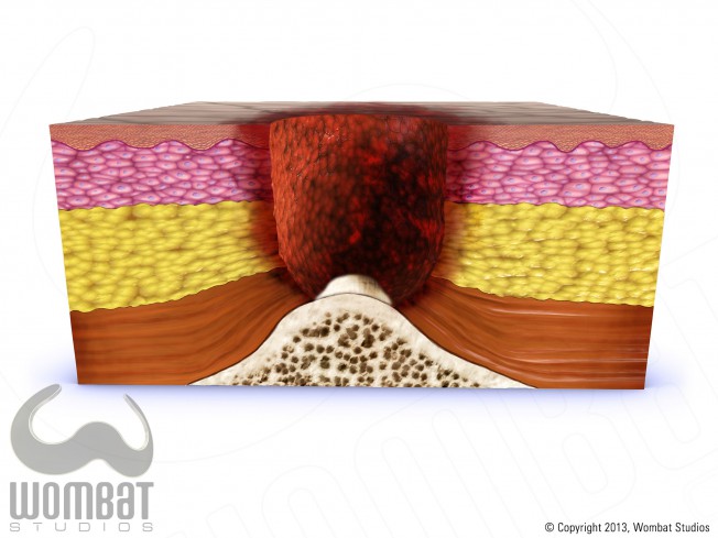 Skin Layers - Stage 4 Pressure Ulcer