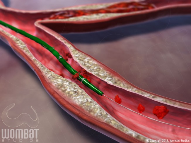 Solent - Removing Thrombus