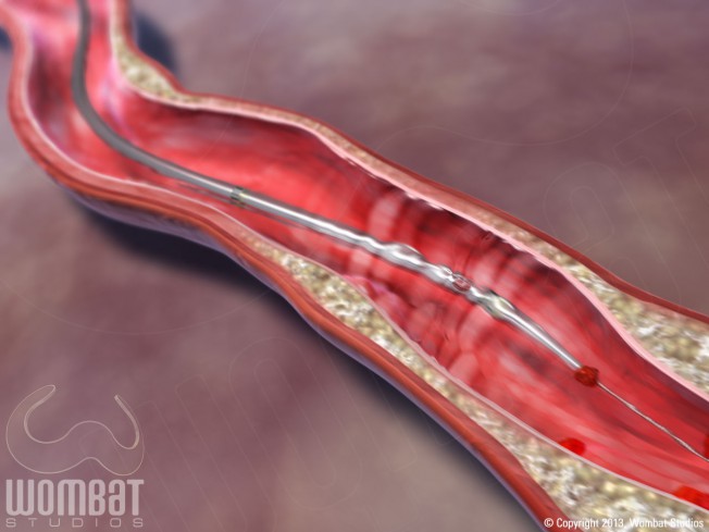 Solent Dista - Removing Thrombus