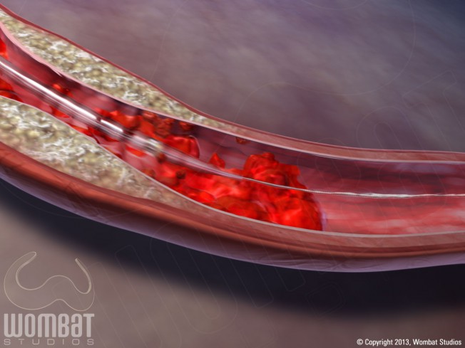 Solent Dista - Removing Thrombus