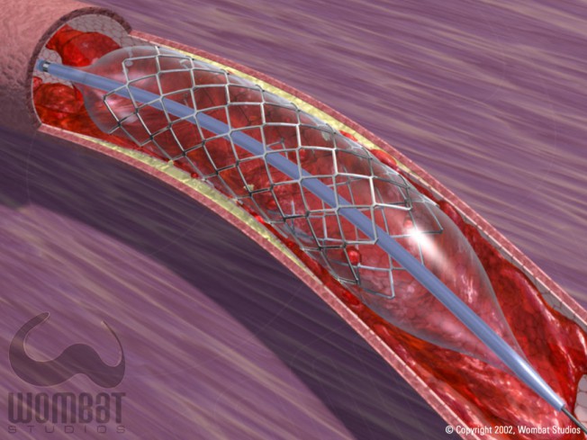 Stent Smashing Clot